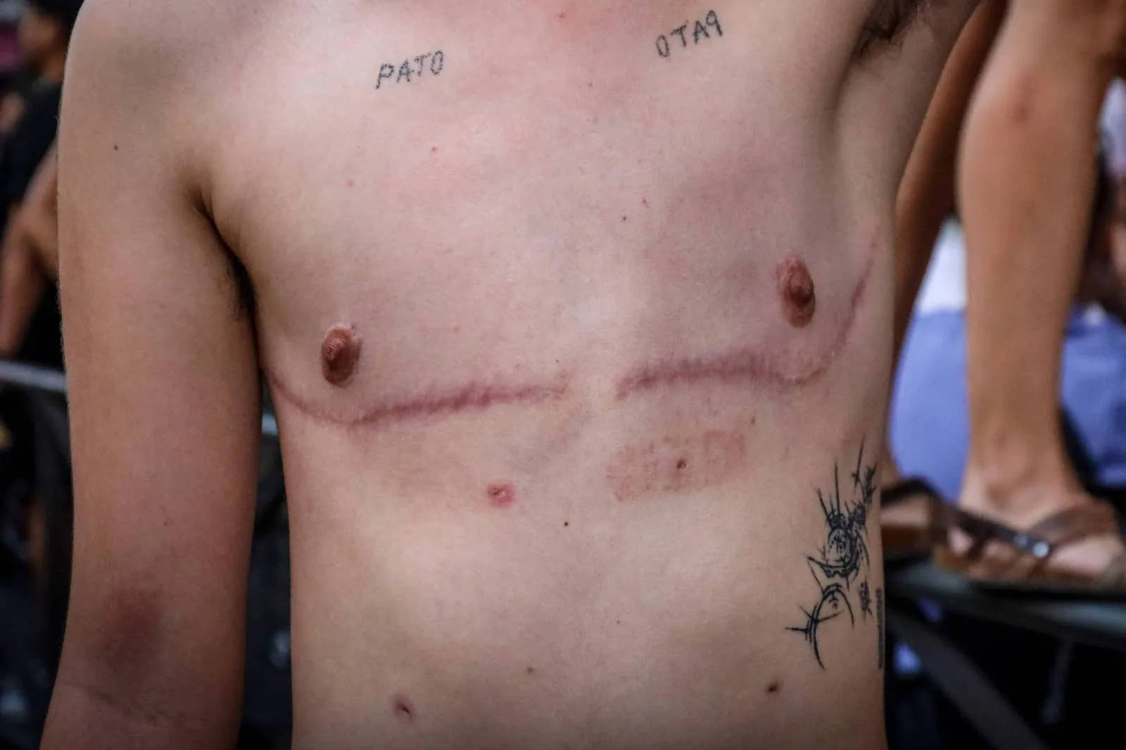 Brust-Amputation bei Minderjährigen – Schweizer Zeitschrift unterdrückt Fachdiskurs